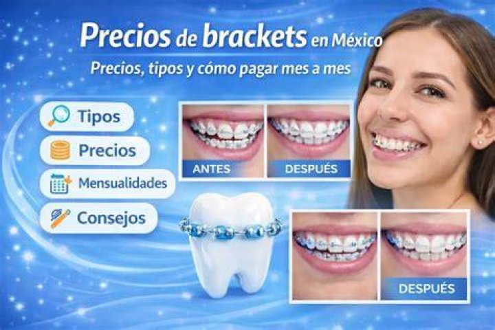 Cuanto Cuestan Unos Brackets Un Precio Justo