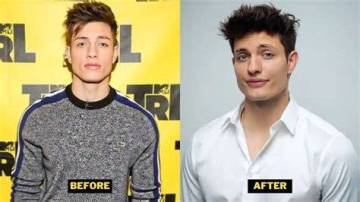 Matt Rife Before And After Did The Comedian Undergo Plastic Surgeries