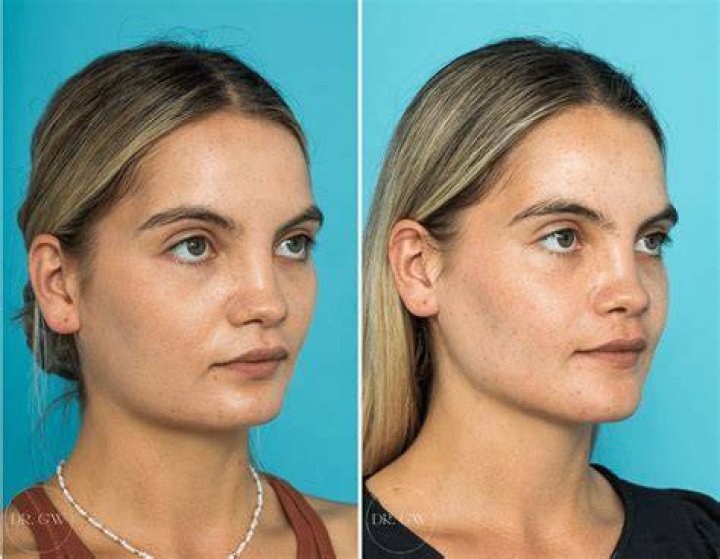 Patient 146804124 Jawline Augmentation Before & After Photos Laser
