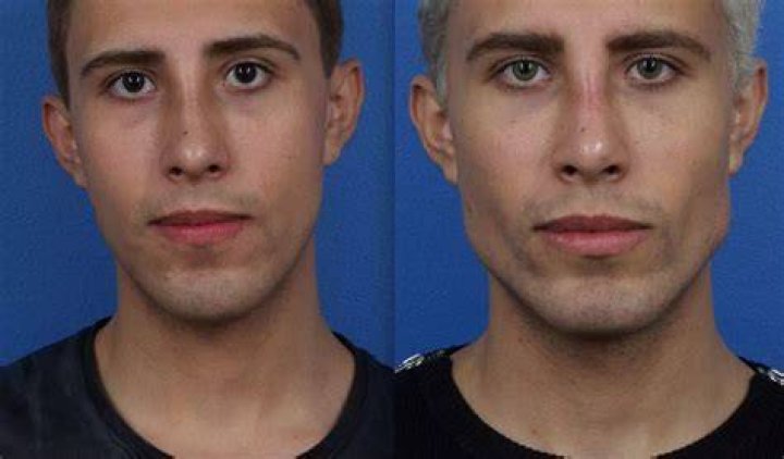 Pec Enhancements, Jawline, and Liposculpting in NYCMale Plastic Surgery